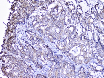 CTTN / Cortactin Antibody - IHC staining of FFPE human gastric carcinoma with Cortactin antibody at 1ug/ml. HIER: boil tissue sections in pH6, 10mM citrate buffer, for 10-20 min followed by cooling at RT for 20 min.