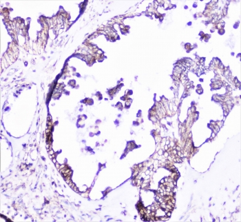 CTTN / Cortactin Antibody - IHC staining of FFPE human ovarian carcinoma with Cortactin antibody at 1ug/ml. HIER: boil tissue sections in pH6, 10mM citrate buffer, for 10-20 min followed by cooling at RT for 20 min.