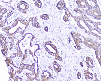 CTTN / Cortactin Antibody - IHC staining of FFPE human cholangiocarcinoma carcinoma with Cortactin antibody at 1ug/ml. HIER: boil tissue sections in pH6, 10mM citrate buffer, for 10-20 min followed by cooling at RT for 20 min.
