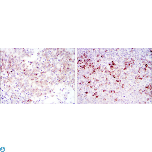 CTTN / Cortactin Antibody - Immunohistochemistry (IHC) analysis of paraffin-embedded cervical cancer tissues (left) and tonsil tissues (right) with DAB staining using Cortactin Monoclonal Antibody.