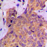 CTTN / Cortactin Antibody - Immunohistochemical analysis of Cortactin (pY421) staining in human breast cancer formalin fixed paraffin embedded tissue section. The section was pre-treated using heat mediated antigen retrieval with sodium citrate buffer (pH 6.0). The section was then incubated with the antibody at room temperature and detected using an HRP conjugated compact polymer system. DAB was used as the chromogen. The section was then counterstained with hematoxylin and mounted with DPX.