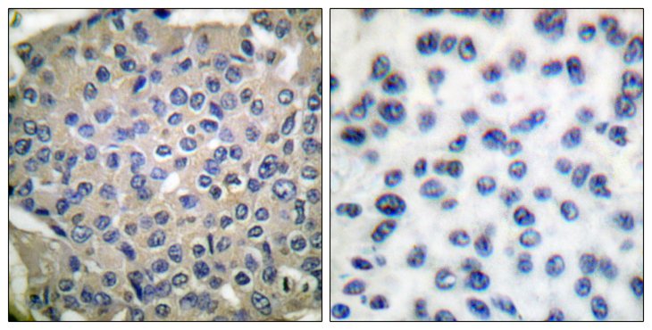 CTTN / Cortactin Antibody - Immunohistochemistry analysis of paraffin-embedded human breast carcinoma, using Cortactin (Phospho-Tyr466) Antibody. The picture on the right is blocked with the phospho peptide.