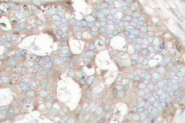 CTTN / Cortactin Antibody - IHC of Cortactin (P415) pAb in paraffin-embedded human prostate carcinoma tissue.