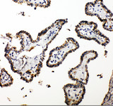 CUEDC2 Antibody - CUEDC2 antibody. IHC(P): Human Thyroid Cancer Tissue.