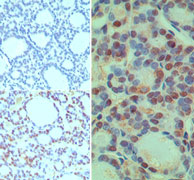 CUEDC2 Antibody - IHC ofCUEDC2 in formalin-fixed paraffin-embedded human thyroid tissue using an isotype control (top left) and Polyclonal Antibody to CUEDC2 (bottom left, right) at5 ug/ml.