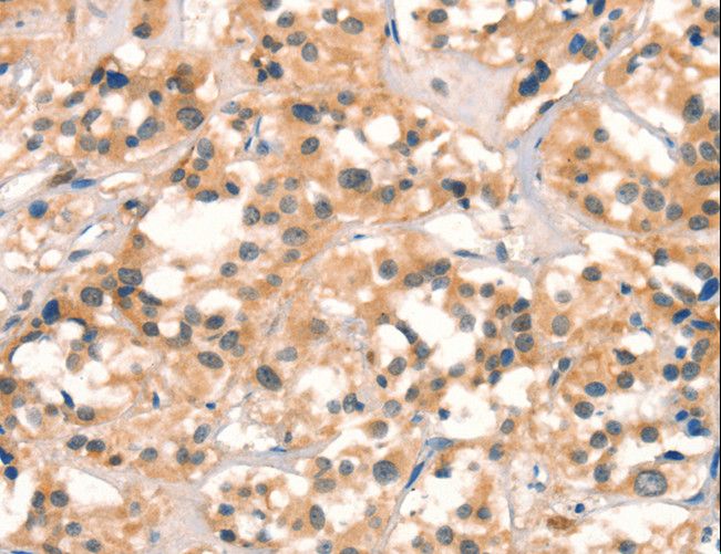 CUEDC2 Antibody - Immunohistochemistry of paraffin-embedded Human thyroid cancer using CUEDC2 Polyclonal Antibody at dilution of 1:30.