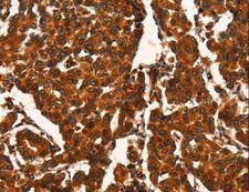 CUEDC2 Antibody - Immunohistochemistry of paraffin-embedded Human breast cancer using CUEDC2 Polyclonal Antibody at dilution of 1:50.