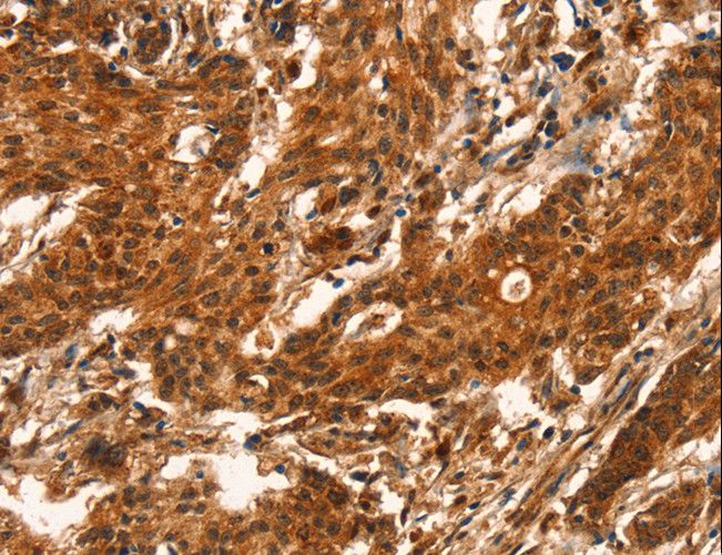 CUEDC2 Antibody - Immunohistochemistry of paraffin-embedded Human gastric cancer using CUEDC2 Polyclonal Antibody at dilution of 1:50.