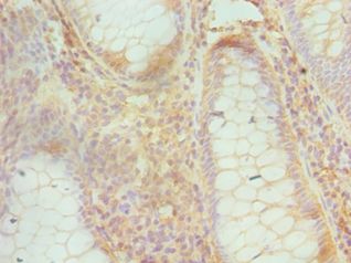 CUL1 / Cullin 1 Antibody - Immunohistochemistry of paraffin-embedded human colon cancer using antibody at 1:100 dilution.
