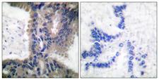CUL1 / Cullin 1 Antibody - Peptide - + Immunohistochemical analysis of paraffin-embedded human lung carcinoma tissue using Cullin 1 antibody.