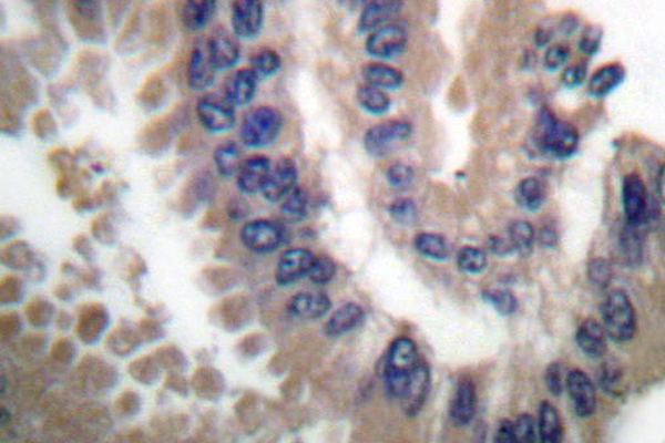 CUL1 / Cullin 1 Antibody - IHC of Cullin 1 (Y761) pAb in paraffin-embedded human lung carcinoma tissue.