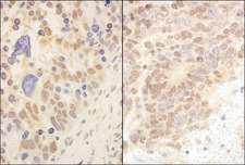 CUL2 / Cullin 2 Antibody - Detection of Human and Mouse Cul2 by Immunohistochemistry. Sample: FFPE section of human ovarian carcinoma (left) and mouse teratoma (right). Antibody: Affinity purified rabbit anti-Cul2 used at a dilution of 1:5000 (0.2 ug/ml) and 1:1000 (1 ug/ml). Detection: DAB.