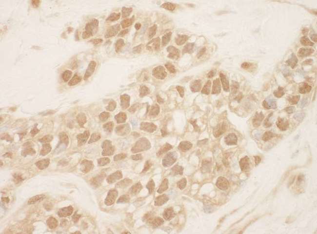 CUL2 / Cullin 2 Antibody - Detection of Human Cul2 by Immunohistochemistry. Sample: FFPE section of human breast carcinoma. Antibody: Affinity purified rabbit anti-Cul2 used at a dilution of 1:100.