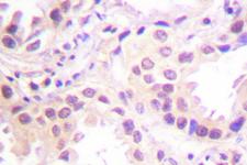 CUL2 / Cullin 2 Antibody - IHC of Cullin 2 (I726) pAb in paraffin-embedded human lung carcinoma tissue.