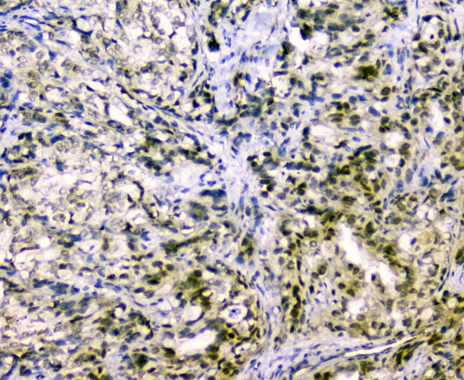 CUL2 / Cullin 2 Antibody - IHC analysis of CUL2 using anti-CUL2 antibody. CUL2 was detected in paraffin-embedded section of human gastric cancer tissues. Heat mediated antigen retrieval was performed in citrate buffer (pH6, epitope retrieval solution) for 20 mins. The tissue section was blocked with 10% goat serum. The tissue section was then incubated with 1µg/ml rabbit anti-CUL2 Antibody overnight at 4°C. Biotinylated goat anti-rabbit IgG was used as secondary antibody and incubated for 30 minutes at 37°C. The tissue section was developed using Strepavidin-Biotin-Complex (SABC) with DAB as the chromogen.