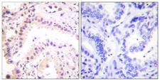 CUL2 / Cullin 2 Antibody - Peptide - + Immunohistochemical analysis of paraffin-embedded human lung carcinoma tissue using Cullin 2 antibody.