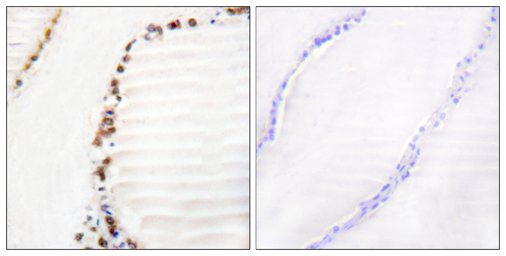 CUL3 / Cullin 3 Antibody - Immunohistochemistry analysis of paraffin-embedded human thyroid gland tissue, using Cullin 3 Antibody. The picture on the right is blocked with the synthesized peptide.