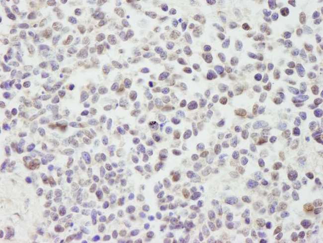 CUL3 / Cullin 3 Antibody - Detection of Human Cul3 by Immunohistochemistry. Sample: FFPE section of human non-small cell lung cancer. Antibody: Affinity purified rabbit anti-Cul3 used at a dilution of1:1000 (1 ug/ml). Detection: DAB.