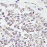 CUL3 / Cullin 3 Antibody - Detection of Human Cul3 by Immunohistochemistry. Sample: FFPE section of human non-small cell lung cancer. Antibody: Affinity purified rabbit anti-Cul3 used at a dilution of 1:250.