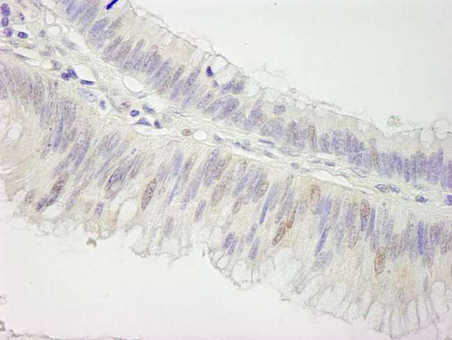 CUL3 / Cullin 3 Antibody - Detection of Human Cul3 by Immunohistochemistry. Sample: FFPE section of human colon carcinoma. Antibody: Affinity purified rabbit anti-Cul3 used at a dilution of 1:250.