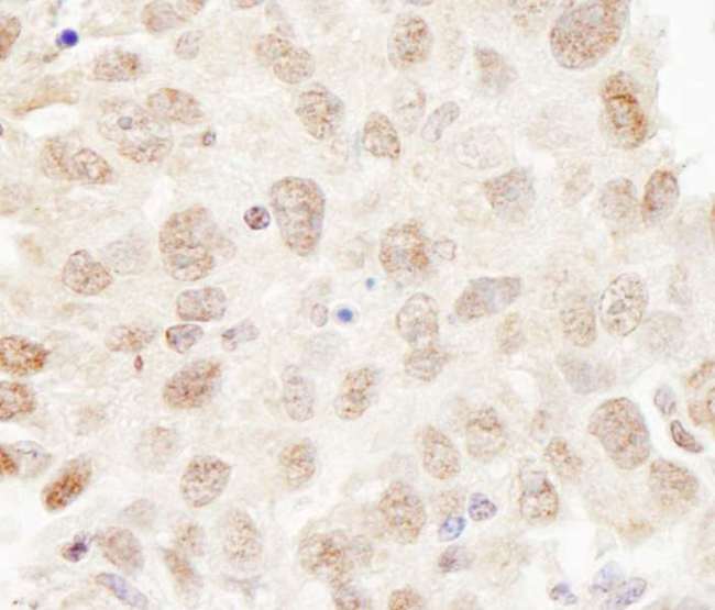 CUL3 / Cullin 3 Antibody - Detection of Human Cul3 by Immunohistochemistry. Sample: FFPE section of human breast carcinoma. Antibody: Affinity purified rabbit anti-Cul3 used at a dilution of1:200 (1 ug/ml). Detection: DAB.