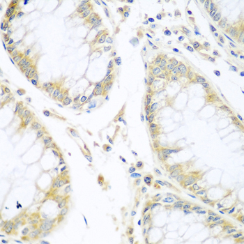 CUL3 / Cullin 3 Antibody - Immunohistochemistry of paraffin-embedded human gastric cancer using CUL3 antibodyat dilution of 1:100 (40x lens).