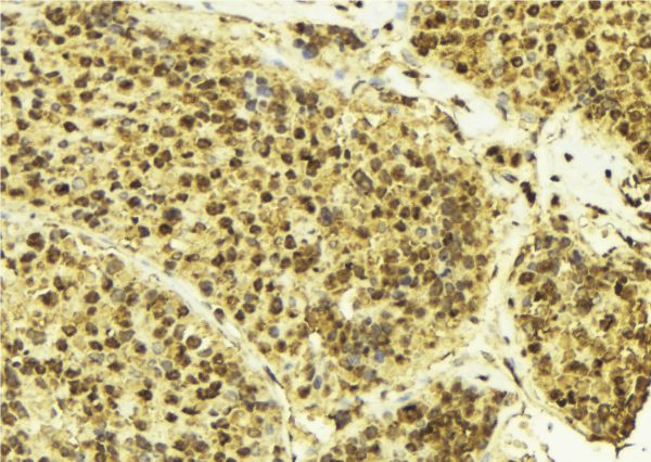 CUL3 / Cullin 3 Antibody - 1:100 staining human breast carcinoma tissue by IHC-P. The sample was formaldehyde fixed and a heat mediated antigen retrieval step in citrate buffer was performed. The sample was then blocked and incubated with the antibody for 1.5 hours at 22°C. An HRP conjugated goat anti-rabbit antibody was used as the secondary.