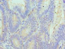 CUL5 / Cullin-5 Antibody - Immunohistochemistry of paraffin-embedded human colon cancer using antibody at 1:100 dilution.