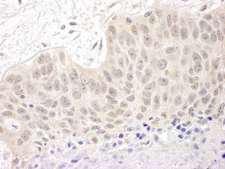 CUL5 / Cullin-5 Antibody - Detection of Human Cul5 by Immunohistochemistry. Sample: FFPE section of human non-small cell lung cancer. Antibody: Affinity purified rabbit anti-Cul5 used at a dilution of 1:250.
