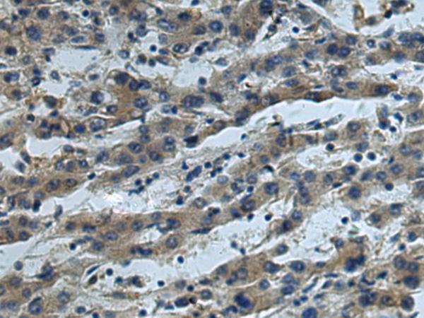 CUL5 / Cullin-5 Antibody - Immunohistochemistry of paraffin-embedded Human liver cancer tissue  using CUL5 Polyclonal Antibody at dilution of 1:55(×200)