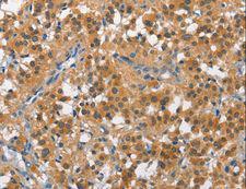 CUL7 Antibody - Immunohistochemistry of paraffin-embedded Human cervical cancer using CUL7 Polyclonal Antibody at dilution of 1:50.