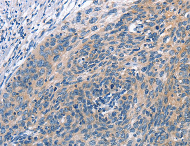 CUL7 Antibody - Immunohistochemistry of paraffin-embedded Human cervical cancer using CUL7 Polyclonal Antibody at dilution of 1:50.