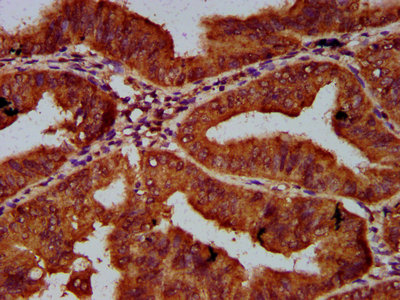 CUL7 Antibody - Immunohistochemistry Dilution at 1:600 and staining in paraffin-embedded human endometrial cancer performed on a Leica BondTM system. After dewaxing and hydration, antigen retrieval was mediated by high pressure in a citrate buffer (pH 6.0). Section was blocked with 10% normal Goat serum 30min at RT. Then primary antibody (1% BSA) was incubated at 4°C overnight. The primary is detected by a biotinylated Secondary antibody and visualized using an HRP conjugated SP system.