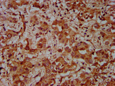 CUL7 Antibody - Immunohistochemistry Dilution at 1:600 and staining in paraffin-embedded human liver cancer performed on a Leica BondTM system. After dewaxing and hydration, antigen retrieval was mediated by high pressure in a citrate buffer (pH 6.0). Section was blocked with 10% normal Goat serum 30min at RT. Then primary antibody (1% BSA) was incubated at 4°C overnight. The primary is detected by a biotinylated Secondary antibody and visualized using an HRP conjugated SP system.
