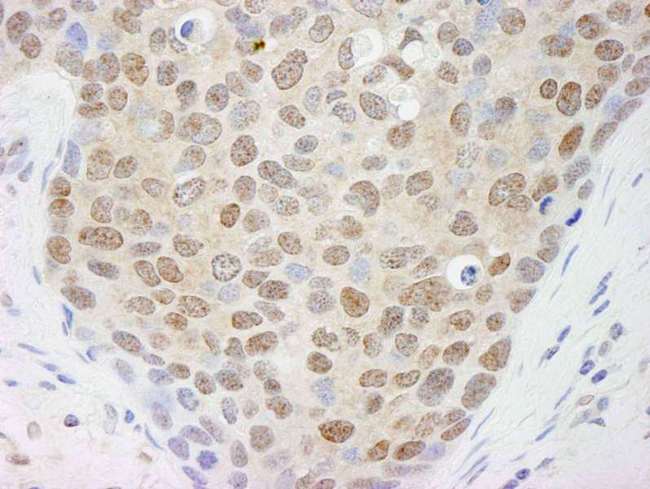 Cullin 4A / CUL4A Antibody - Detection of Human Cul4a by Immunohistochemistry. Sample: FFPE section of human breast tumor. Antibody: Affinity purified rabbit anti-Cul4a used at a dilution of 1:500.