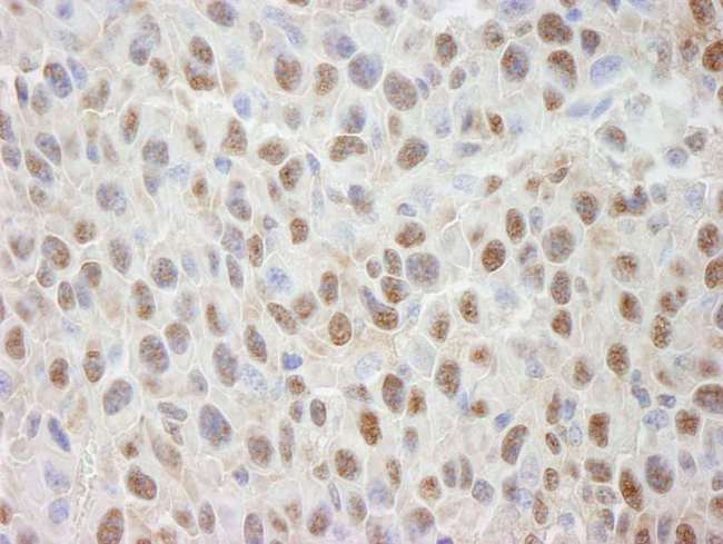 Cullin 4A / CUL4A Antibody - Detection of Mouse Cul4a by Immunohistochemistry. Sample: FFPE section of mouse squamous cell carcinoma. Antibody: Affinity purified rabbit anti-Cul4a used at a dilution of 1:100.