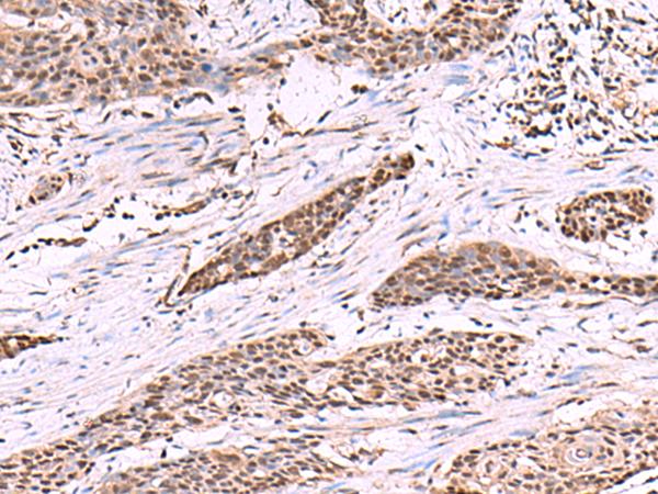 Cullin 4A / CUL4A Antibody - Immunohistochemistry of paraffin-embedded Human esophagus cancer tissue  using CUL4A Polyclonal Antibody at dilution of 1:55(×200)