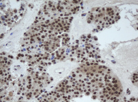 Cullin 4B / CUL4B Antibody - IHC of paraffin-embedded Carcinoma of Human pancreas tissue using anti-CUL4B mouse monoclonal antibody.