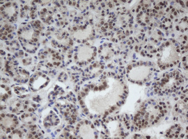 Cullin 4B / CUL4B Antibody - IHC of paraffin-embedded Carcinoma of Human thyroid tissue using anti-CUL4B mouse monoclonal antibody.
