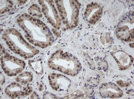 Cullin 4B / CUL4B Antibody - IHC of paraffin-embedded Carcinoma of Human prostate tissue using anti-CUL4B mouse monoclonal antibody.