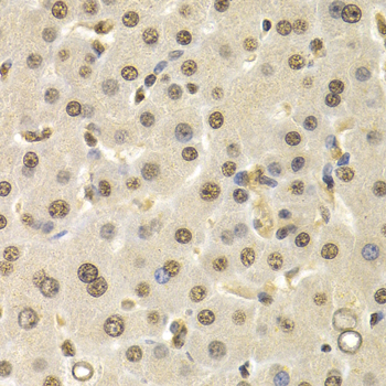 Cullin 4B / CUL4B Antibody - Immunohistochemistry of paraffin-embedded human liver cancer tissue.