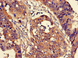 CUTA Antibody - Immunohistochemistry of paraffin-embedded human colon cancer at dilution of 1:100