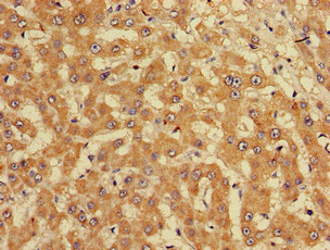 CUTA Antibody - Immunohistochemistry of paraffin-embedded human liver cancer at dilution of 1:100