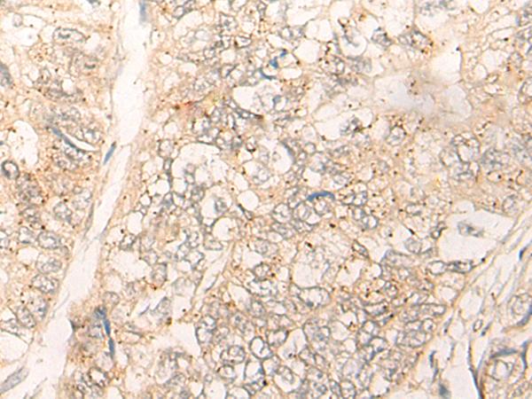 CUTA Antibody - Immunohistochemistry of paraffin-embedded Human gastric cancer tissue  using CUTA Polyclonal Antibody at dilution of 1:40(×200)