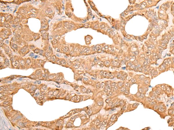 CUTA Antibody - Immunohistochemistry of paraffin-embedded Human thyroid cancer tissue  using CUTA Polyclonal Antibody at dilution of 1:45(×200)