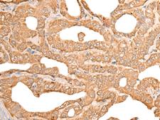 CUTA Antibody - Immunohistochemistry of paraffin-embedded Human thyroid cancer tissue  using CUTA Polyclonal Antibody at dilution of 1:45(×200)