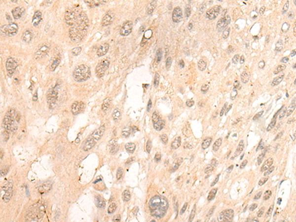 CUTA Antibody - Immunohistochemistry of paraffin-embedded Human esophagus cancer tissue  using CUTA Polyclonal Antibody at dilution of 1:45(×200)