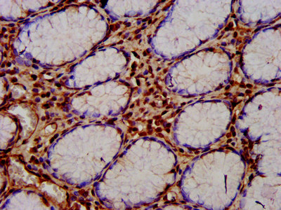 CUTC Antibody - Immunohistochemistry image at a dilution of 1:400 and staining in paraffin-embedded human gastric cancer performed on a Leica BondTM system. After dewaxing and hydration, antigen retrieval was mediated by high pressure in a citrate buffer (pH 6.0) . Section was blocked with 10% normal goat serum 30min at RT. Then primary antibody (1% BSA) was incubated at 4 °C overnight. The primary is detected by a biotinylated secondary antibody and visualized using an HRP conjugated SP system.