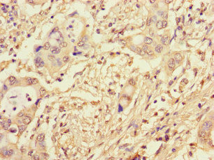 CWC22 Antibody - Immunohistochemistry of paraffin-embedded human pancreatic cancer at dilution of 1:100