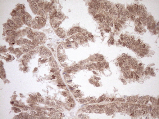 CWC27 Antibody - Immunohistochemical staining of paraffin-embedded Adenocarcinoma of Human ovary tissue using anti-CWC27 mouse monoclonal antibody. (Heat-induced epitope retrieval by 1mM EDTA in 10mM Tris buffer. (pH8.5) at 120°C for 3 min. (1:150)
